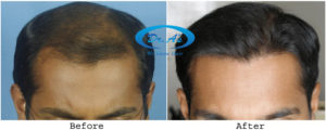 Image_Hair Transplantation_Before & After
