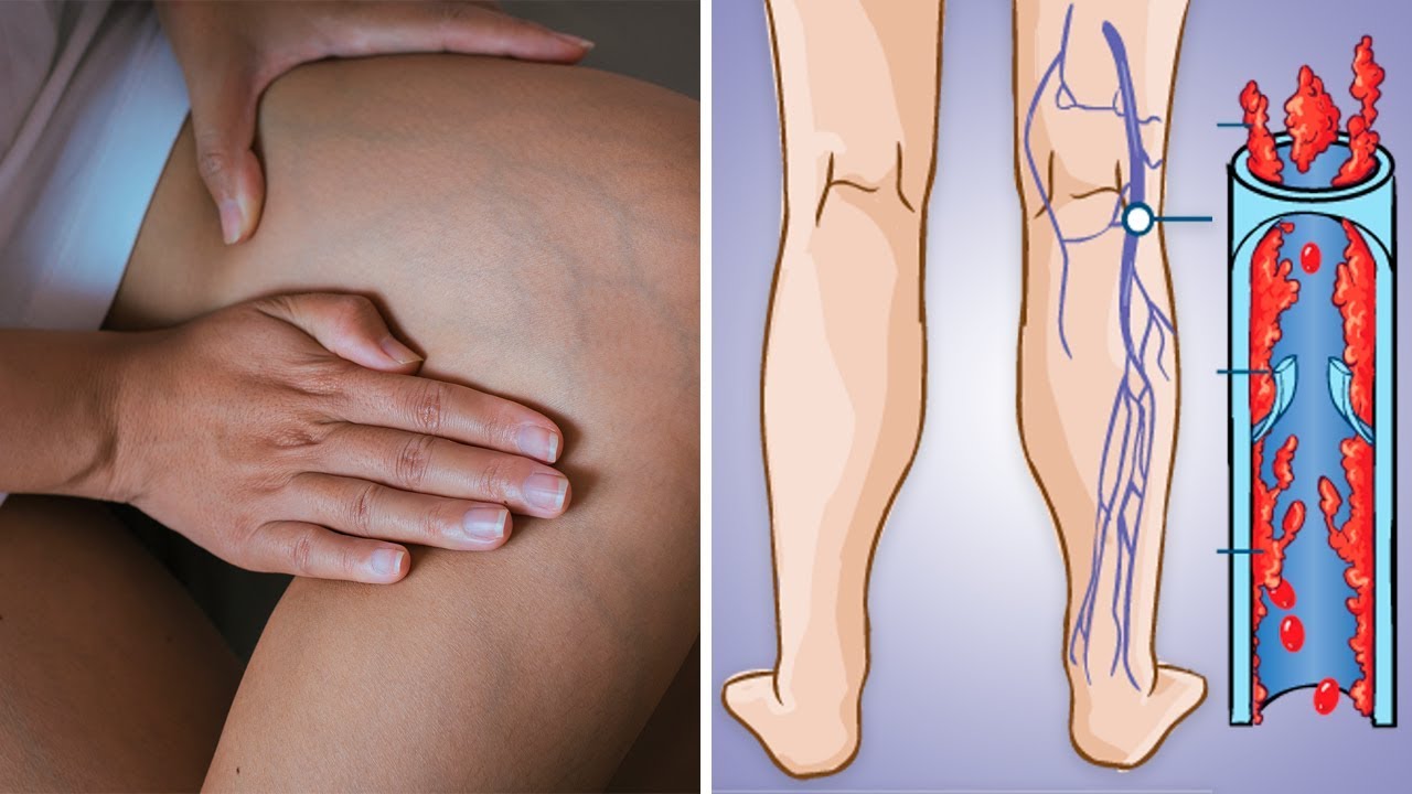 A BLOOD CLOT IN YOUR LEG COULD LEAD TO A RIGHT HEART ...