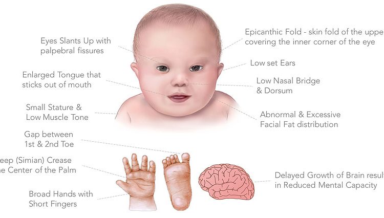 Down S Syndrome The Birth Of A Unique Child Punekar News