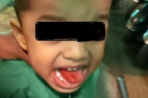 Pune: A Four-Year-Old Gets Tongue Burn After A Waiter Served Washing Soda Instead Of Sugar