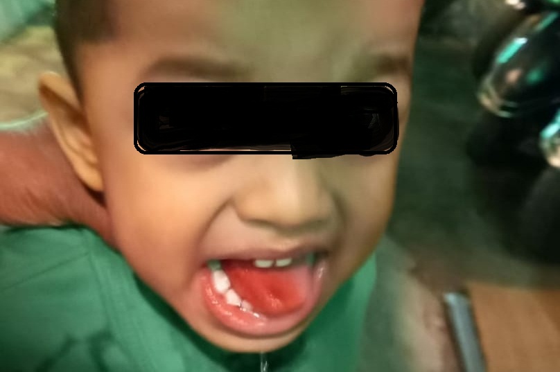 Pune: A Four-Year-Old Gets Tongue Burn After A Waiter Served Washing Soda Instead Of Sugar