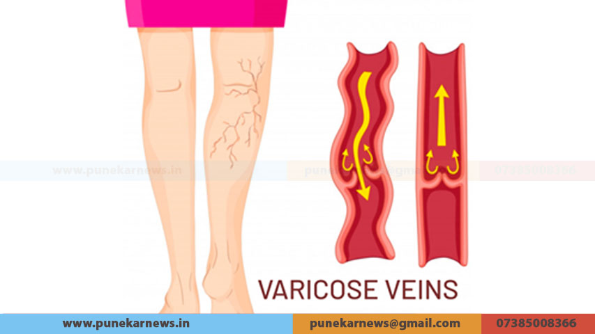 VARICOSE VIENS