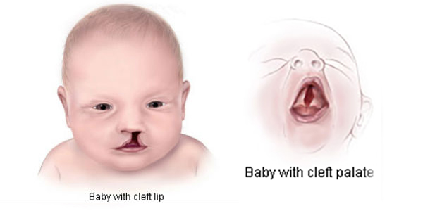 CLEFT