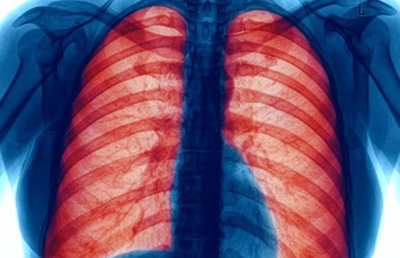 copd Chronic Obstructive Pulmonary Disease