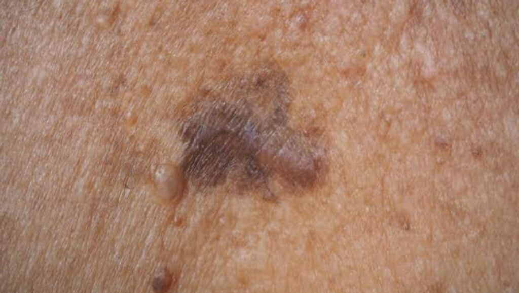 Skin Cancer