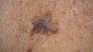 Skin Cancer
