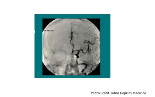Brain Aneurysm