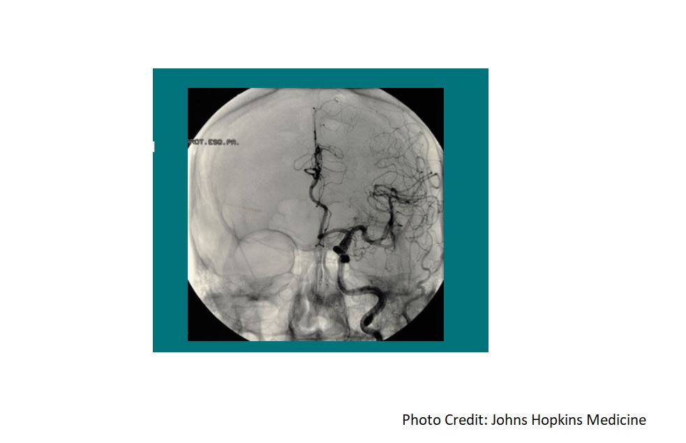 Brain Aneurysm