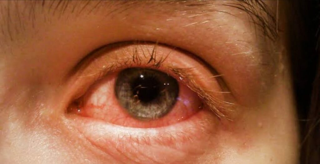 Conjunctivitis