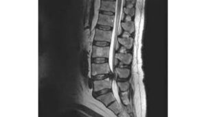 spinal canal