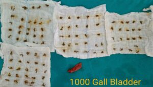 1000 Stones Successfully Removed from 30-Year-Old Woman