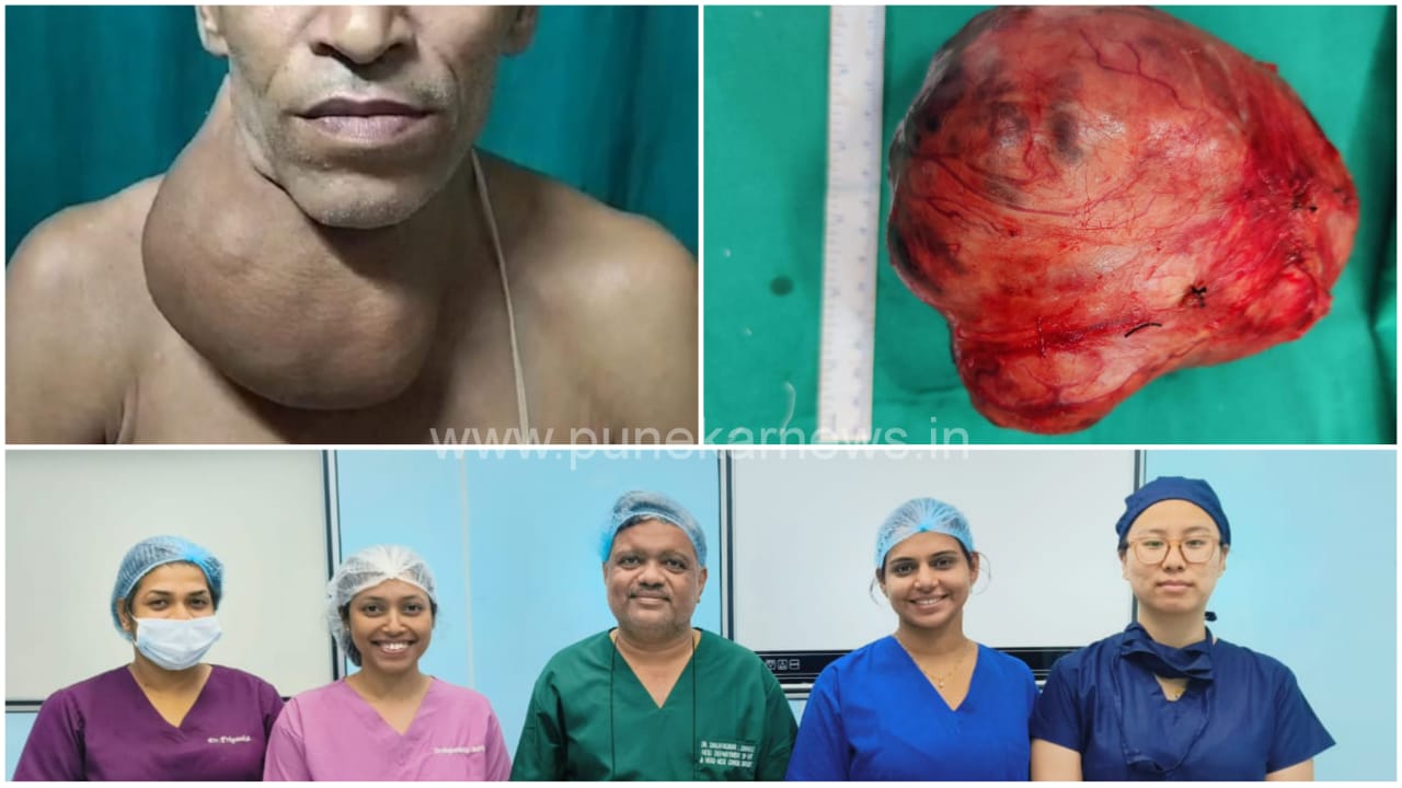 Pune: Doctors At Sassoon Hospital Perform Rare Surgery To Remove 1.5 Kg Thyroid Tumor
