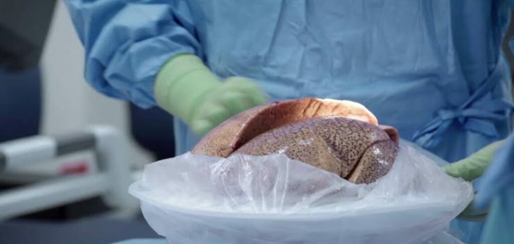 Lungs Transplant