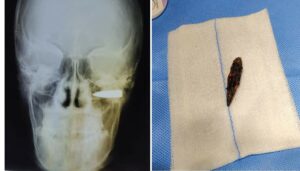 Complex Surgery