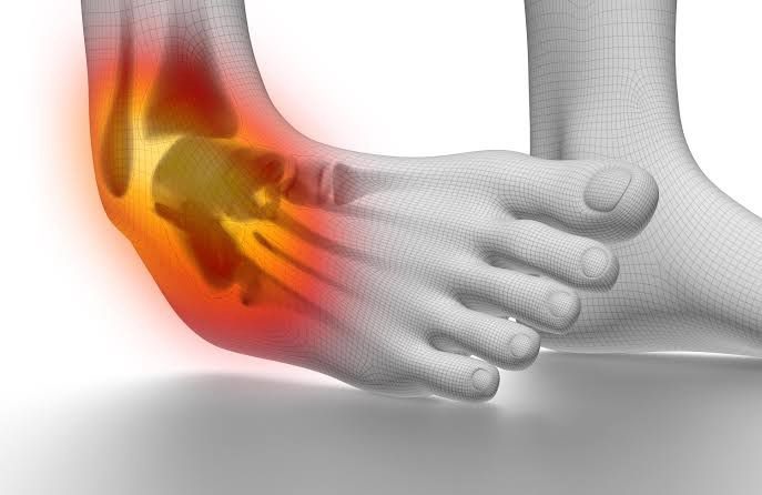 ankle sprain