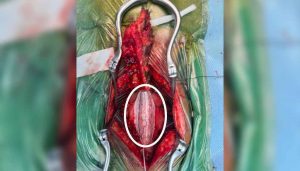 spine tumor