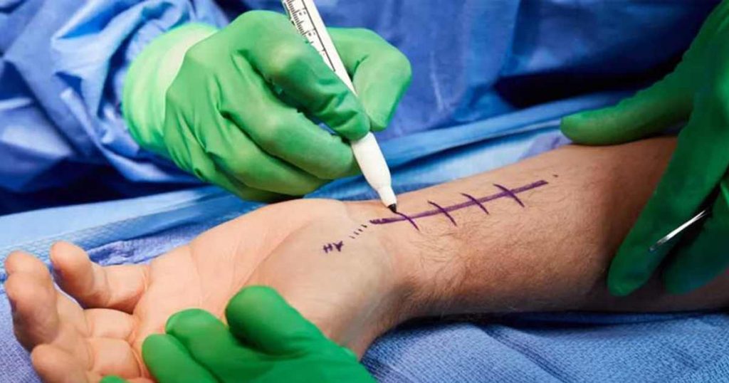 Hand surgery (1)