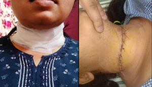 Young Singer Suffers Severe Neck Injury from Banned Nylon Kite String in Pune