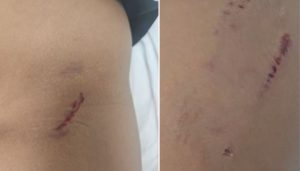 9-Year-Old Girl Injured in Dog Attack at Baner Society