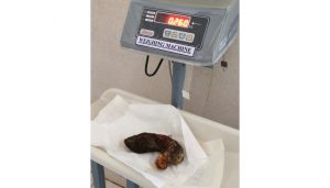 Doctors at Symbiosis Hospital Remove 280g Hair and Thread Mass